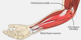 The last week has been better, but it still feels pretty messed up, and i can't use more than about 25% of my strength safely. How To Fix Elbow Pain Louisiana Golf Association