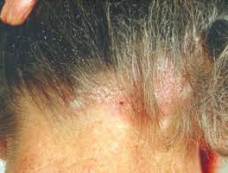 Seborrheic dermatitis can move beyond the scalp, where it is usually considered to be more aggressive and persistent. Seborrhoeic Dermatitis Dermnet Nz