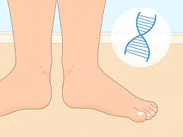 Image result for Out-toeing