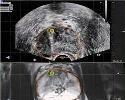 Prostate cancer is one of the most common types of cancer diagnosed in men. State Of The Art Uronav Fusion Biopsy Prostate Cancer Testing Dr David Samadi Prostate Cancer Center