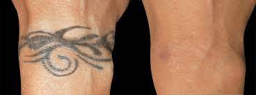 Your options for removing unwanted body hair have multiplied in recent years thanks to technology and new home devices. Laser Tattoo Removal Experts Long Island Perfect Body Laser Aesthetics Long Island Ny