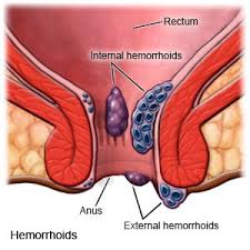 Image result for Hemorrhoid