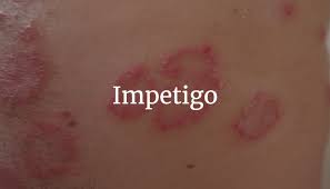 Impetigo – Rocky Point Pavilion Pharmacy