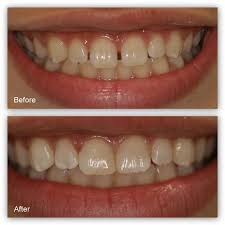Retainers and braces are used to fix tooth gaps because there are risks associated with tooth gaps. Closing Gaps Gallery Dr Jack M Hosner D D S