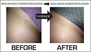 Use products specifically designed for bikini hair removal. 7 Gross But Satisfying Products That Will Get Rid Of Ingrown Hair Ingrown Hair Hair Removal Scrub Arm Hair