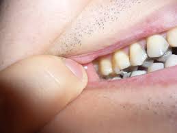 The roots of your teeth have narrow openings called canals containing blood vessels and nerve fibers that provide root canals are performed by a general dentist or a dental specialist known as an endodontist. What Causes Teeth To Need Root Canal