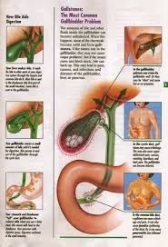 Gallstones Prevent Bile From Reaching Your Intestines And In Turn Prevent Detoxification Cause Liver Stress A Gallbladder Flush Gallbladder Cleanse Gallstones