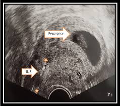 A woman may also become pregnant with an iud if it falls out of place. Case Report Pregnancy While Using An Iud