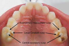 Maybe you would like to learn more about one of these? Canine On Twitter Cusp Of Carabelli Can Be Seen In Maxillary Second Primary Molar