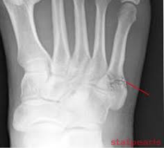 This is another way of saying a jones fracture. 5th Metatarsal Fracture Article