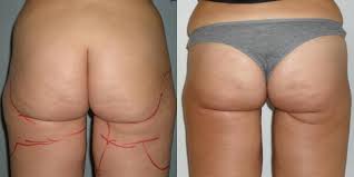 Lifting Interno Cosce Chirurgia Estetica Interno Cosce Costi