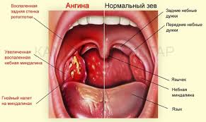 Методы лечения ангины