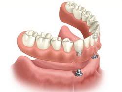 Check spelling or type a new query. Dental Implants Options Procedure Costs