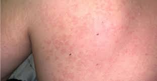 Pielea este o bariera care ne protejeaza de factorii de mediu, insa atunci cand sistemul imunitar este slabit si pot sa apara diverse infectii care se manifesta la. Pitiriazis Versicolor Ce Este È™i Cum Se TrateazÄƒ Dr Leventer Center