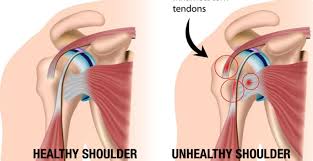 Image result for Shoulder Injection