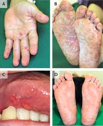 Image result for Hand foot and mouth disease HFMD roof of mouth