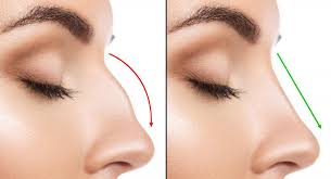 Yes, nasal polyps can be treated with several different options, including nasal sprays, oral medications, nasal polyp suction, and antibiotics. Should I Be Worried About Nasal Polyps Houston Sinus Surgery Ear Nose Throat Doctors