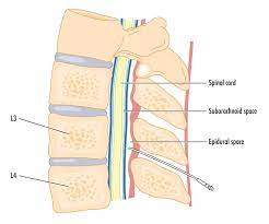 Lumbar Epidural Injection