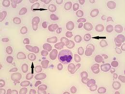 The same peripheral blood smear from a patient with iron deficiency is shown at two different magnifications. Target Cells Codocytes A Laboratory Guide To Clinical Hematology