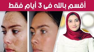 ماسك طبيعي بالبيض والعسل للتخلص من الكلف وبقع الشمس