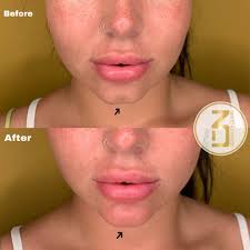 Check spelling or type a new query. Fillers Haka Balancera Ansiktsprofilen V Format Ansikte 3dbeauty Clinic