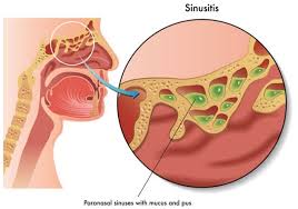 Sarang2 yg membekalkan kuman2 untuk dihantar ke permukaan kulit lalu. January 2017 Bella Idura