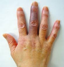 Ein Mittelfinger Erlebt Sein Blaues Wunder Springerlink