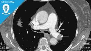 L'embolia polmonare è una patologia causata dall'ostruzione di un vaso sanguigno a livello del la diagnosi di embolia polmonare è fondamentale per fornire soccorso tempestivo al paziente ed è. Tac Spirale Radiologia Italia