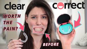 Smile Direct Club vs Clear Correct