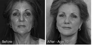 From the Quest for Recognition to Surface Imagination Surgery