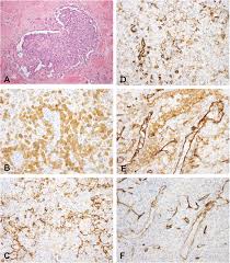 The european medicines agency has validated a type ii variation for nivolumab in. Vasculogenic Mimicry In Malignant Mesothelioma An Experimental And Immunohistochemical Analysis Sciencedirect