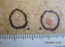 Basal cells are found in the top layer of skin, called the epidermis. Racgp Early Detection And Non Invasive Diagnosis Of Basal Cell Carcinoma Using A Dermatoscope