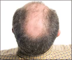 This type of hair loss is unlike other forms of alopecia. Premature Balding