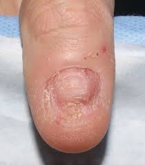 Image result for Onychotillomania feet