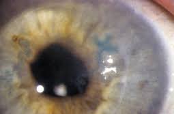 Stromal involvement (stromal keratitis) or uveitis.2,7. Keeping Herpes Under Control