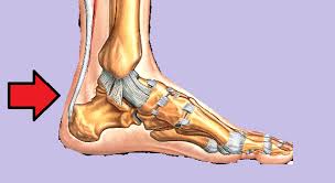 Achilles Tendon Disorders Musculoskeletal Medicine For Medical Students Orthopaedicsone