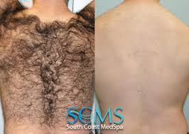 laser hair removal before and after los