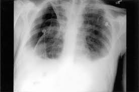 The term bilateral pleural effusion refers to the dysfunction of the lubricating fluid found between both lungs and the chest wall. Bilateral Pleural Effusions And Right Pneumothorax In A 25 Year Old Man Chest