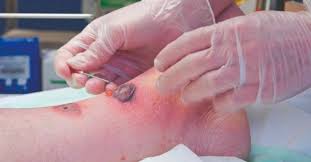 Premature removal of the scab will result would result in delayed healing. Mythbuster I Need To Let The Air Get To This Wound Nursing In Practicenursing In Practice