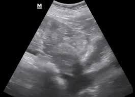 Maybe you would like to learn more about one of these? Abdominal Ultrasound Made Easy Step By Step Guide Pocus 101