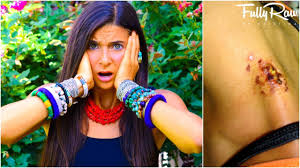 The black widow, found throughout the world's temperate and tropical regions, is indeed the most venomous spider in north america—but the notorious black. I Got Bit By A Black Widow Spider Youtube