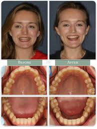 Townie Treatment Case: Can'T Be Tamed By Dr. Adith Venugopal - Orthotown
