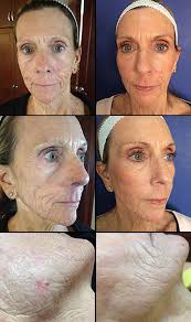 Co2 Laser Skin Resurfacing Dr Monica Scheel Dermatology Kailua Kona Hi