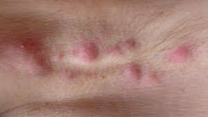 Image result for sore skin in the groin area