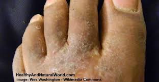 Peeling feet have several potential causes. Skin Peeling Between Toes Causes And Natural Treatments Peeling Skin Dry Peeling Skin Dry Skin Remedies