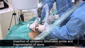Jika tidak ditangani dengan tepat, batu ginjal dapat menyebabkan teknologi terdepan untuk eswl. Operasi Batu Ginjal Sebesar 2cm Atau Lebih Dengan Menggunakan Percutaneous Nephrolithotripsy Youtube