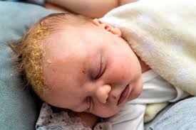 Image result for sores on the head in children
