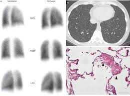 Image result for Ventilation Perfusion Scan