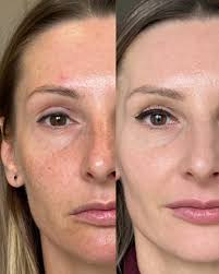 Dzisiaj chcemy pochwalić się tym spektakularnym efektem przed i po 🤩 Nasza  pacjentka miała wykonany zabieg przez naszą kosmetolog @_eliza_155 na  przebarwienia przy użyciu światła szerokopasmowego. Efekt, który widzicie  na zdjęciu PO,