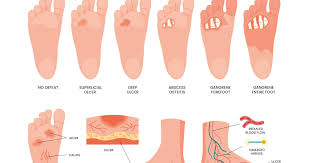 Image result for toe black diabetes